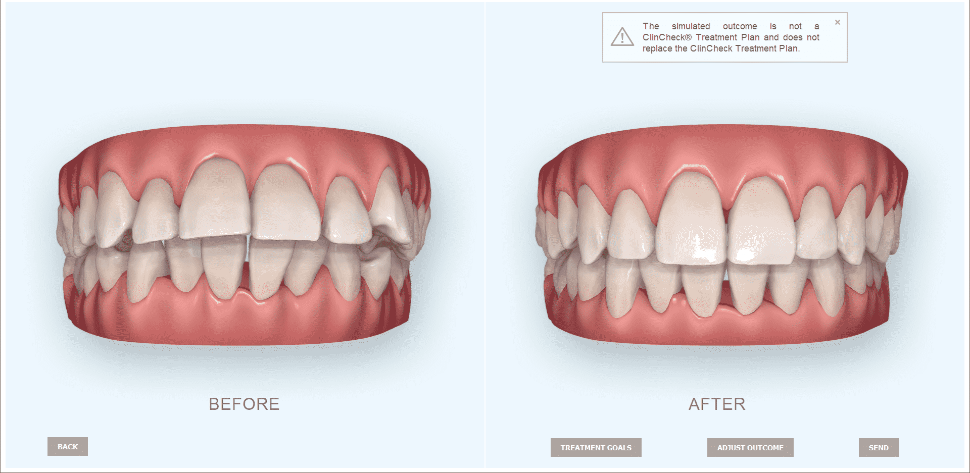 itero-outcome-simulator-invisalign