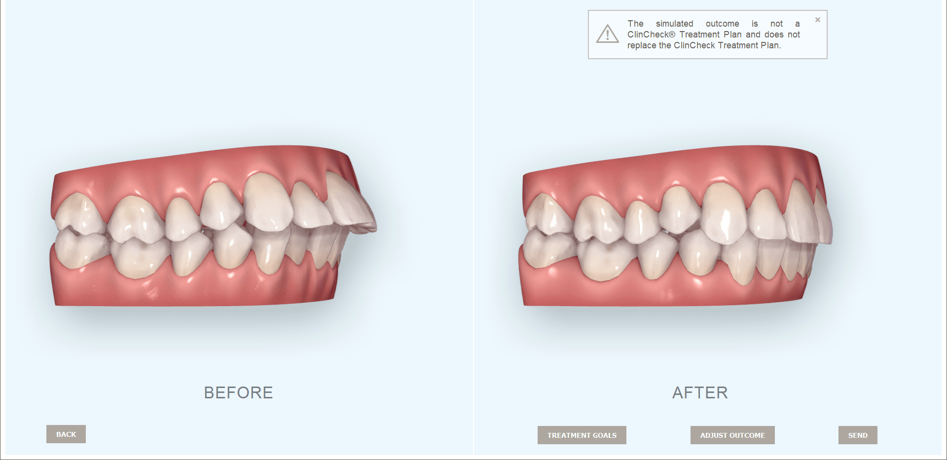 itero-outcome-simulator-invisalign