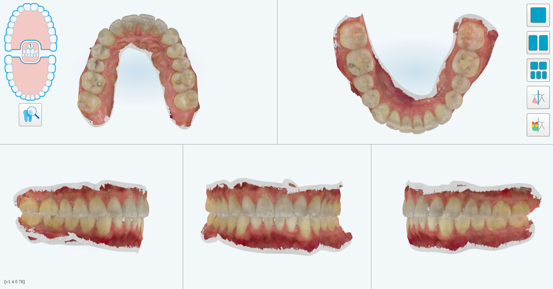 full-arch-scans-itero-element-5d