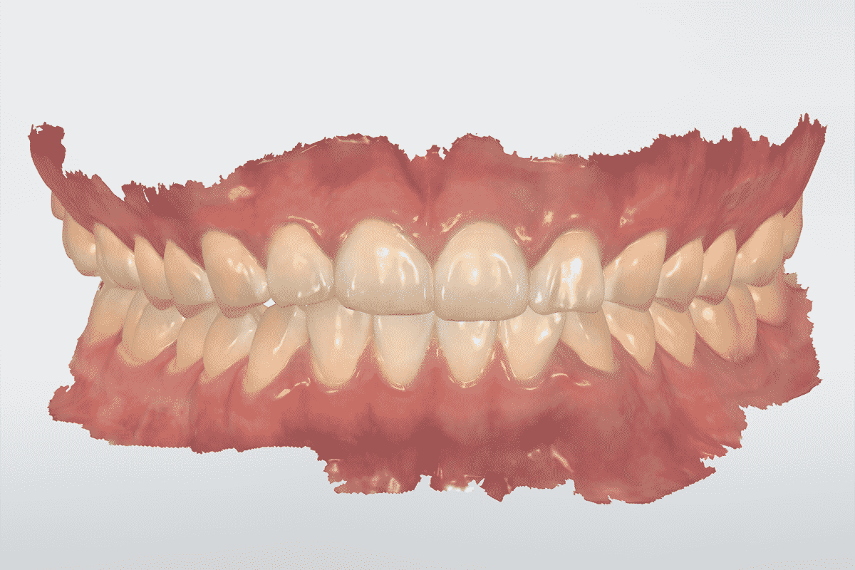 Full-arch-scanning-TRIOS-3SHAPE-TRIOS-4-bite-scan-institute-of-digital-dentistry