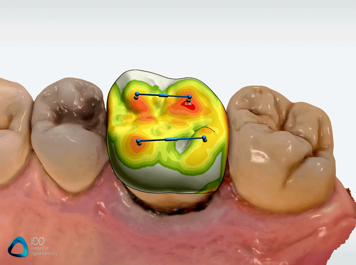 Shape-Design-Studio-crown-design-CAD-CAM-Institute-of-Digital-Dentistry