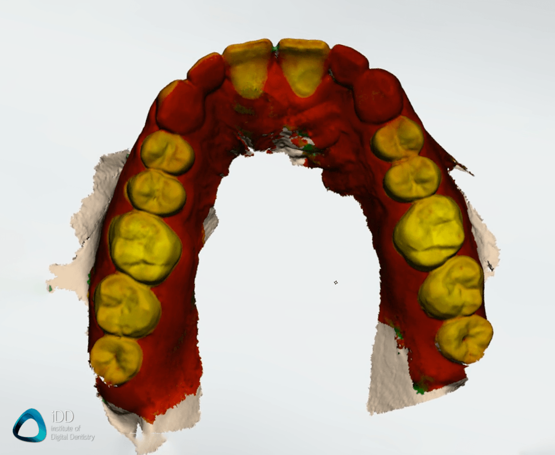 caries-detection-trios-4-function-maxillary-arch-institute-of-digital-dentistry