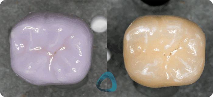 emax glazing course before and after institute of digital dentistry