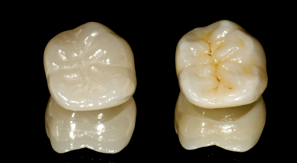 Polishing vs. Glazing Dental CAD/CAM Ceramics (e.max and zirconia