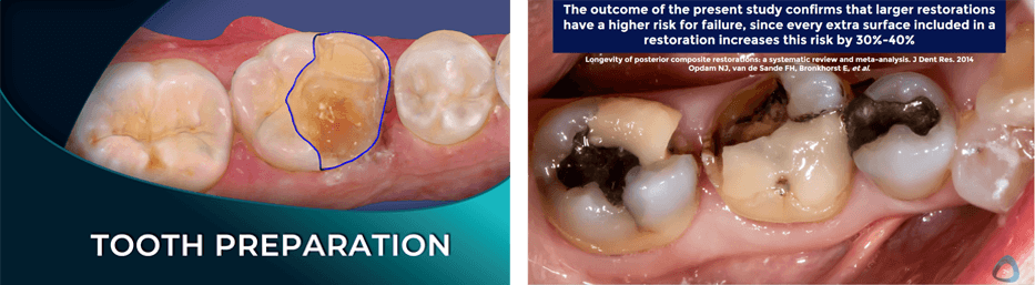 tooth margination and preparation dental online course institute of digital dentistry