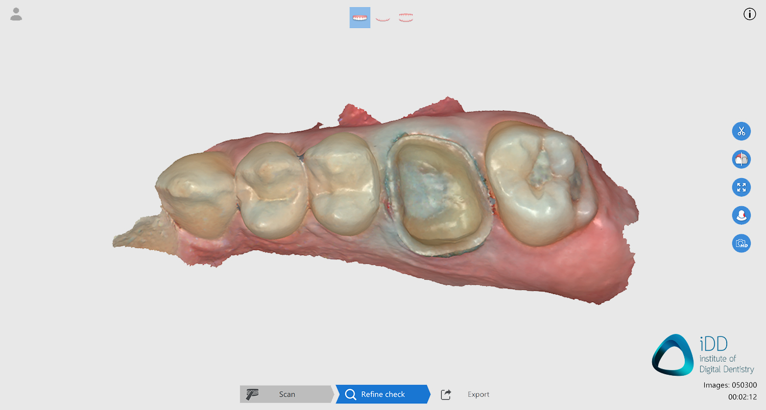 CROWN 2 runyes ios scan after processing institute of digital dentistry-2final