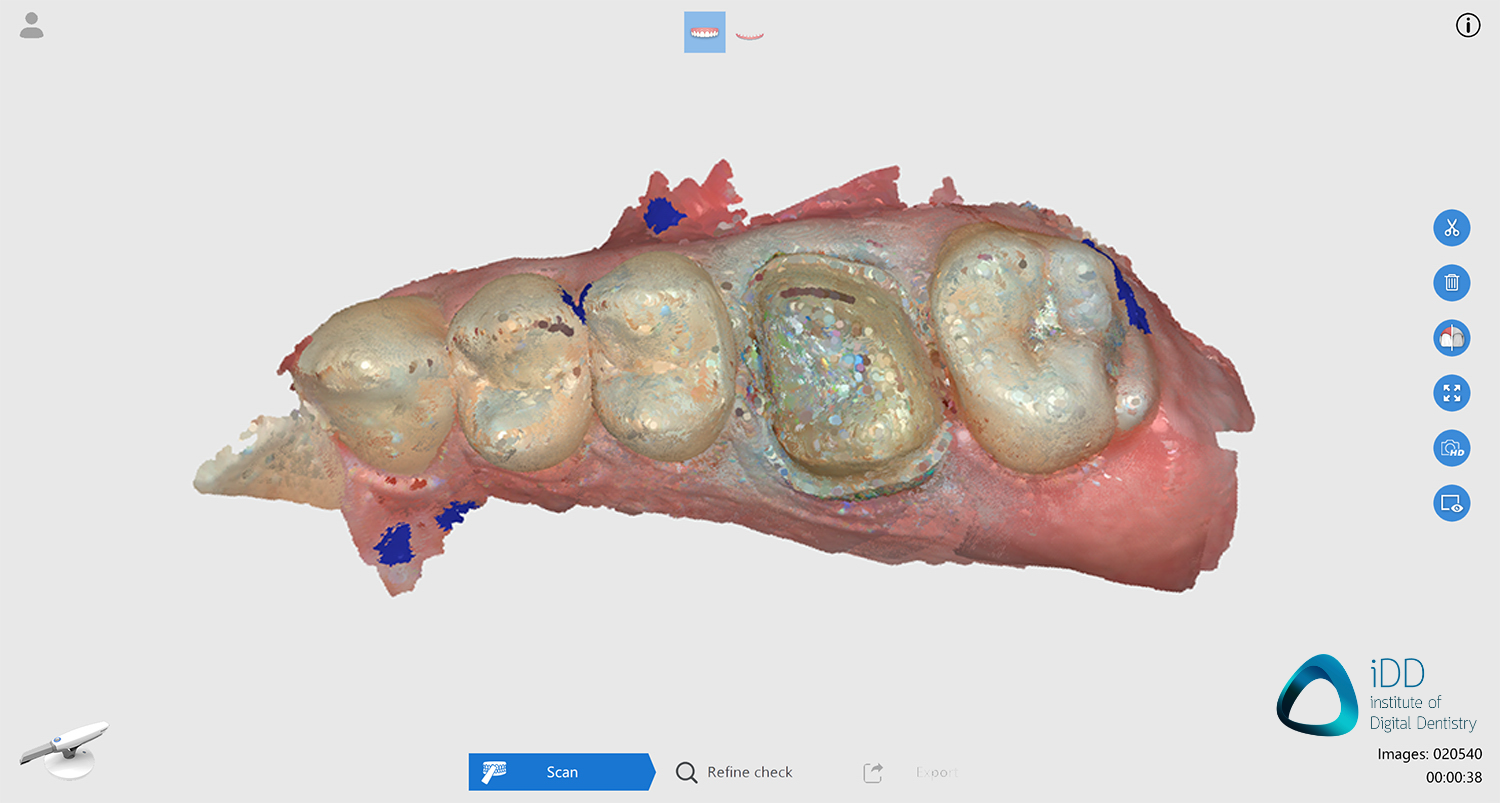 CROWN runyes ios scan after processing institute of digital dentistry-2final