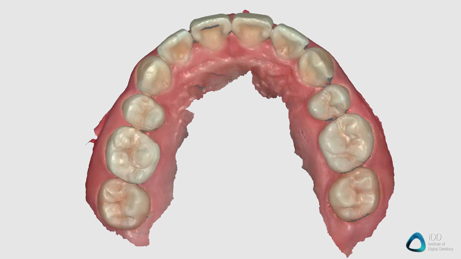 full arch scan runyes 3DS IOS institute of digital dentistry (2)