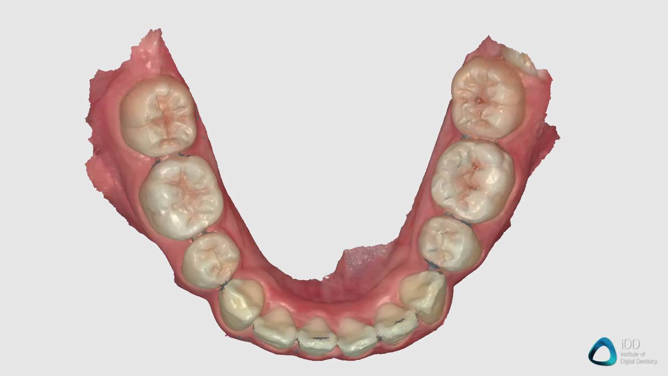 full arch scan runyes 3DS IOS institute of digital dentistry (3)