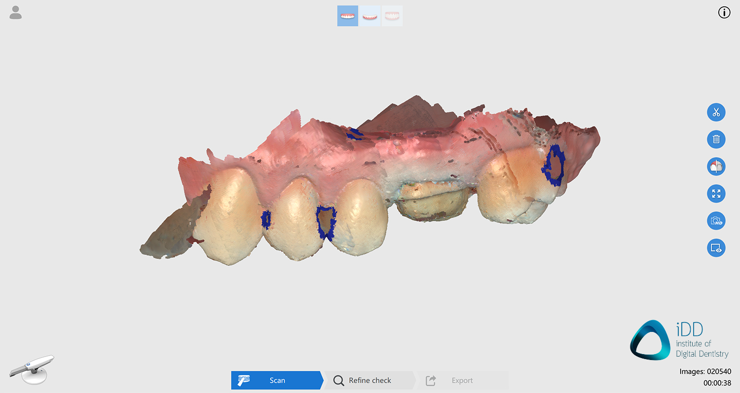 runyes ios scan before processing institute of digital dentistry final