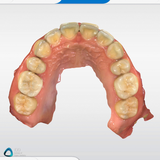 CEREC Primescan scan example review (1)