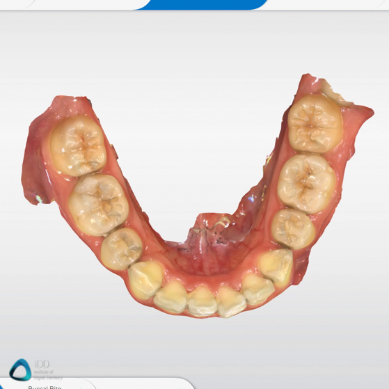 CEREC Primescan scan example review (2)