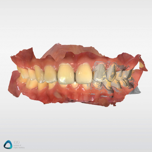 CEREC Primescan scan example review (3)