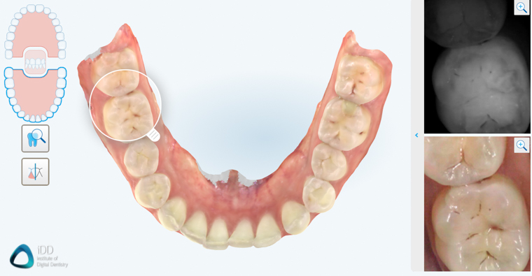 NIRI caries detection itero element 5D plus review full arch scanning institute of digital dentistry-2