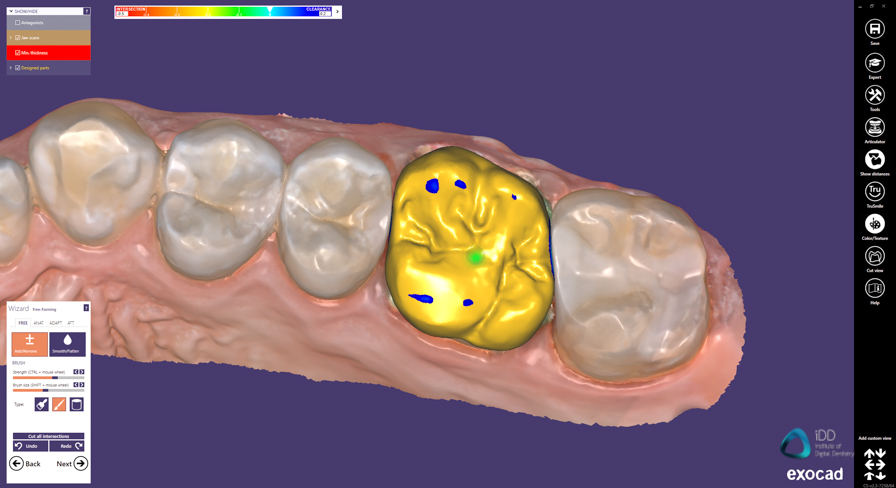 exocad crown workflow institute of digital dentistry (4)