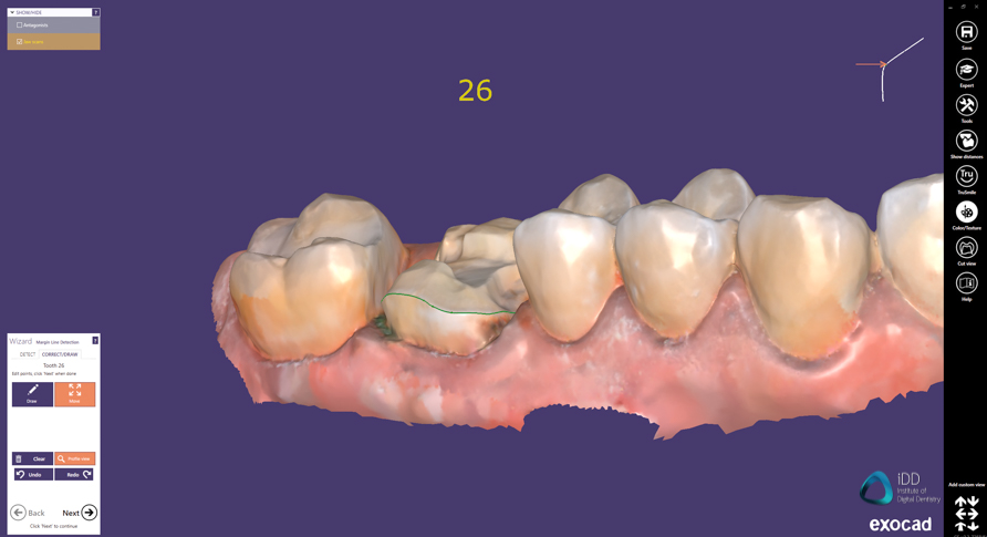 exocad crown workflow institute of digital dentistry (5)