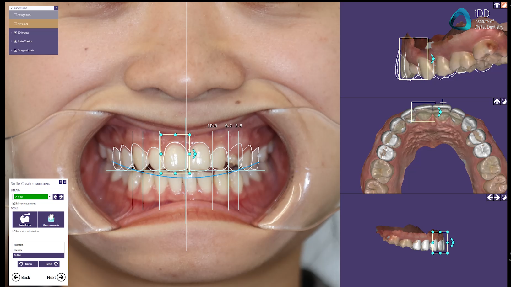 exocad smile creator software digital smile design institute of digital dentistry