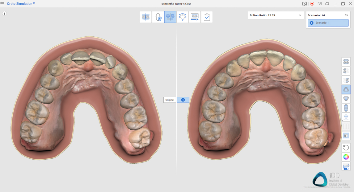 medit link software orthodontic simulator, model base creator, medit i700 institute of digital dentistry (1)