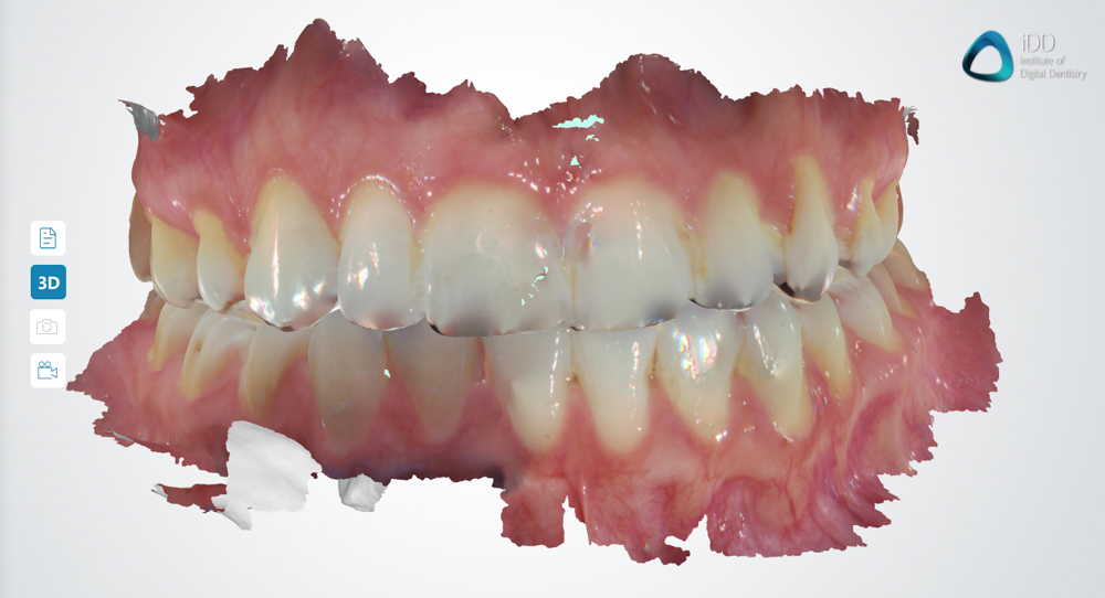 full arch scans dentaLink IOS fussen institute of digital dentistry (1)