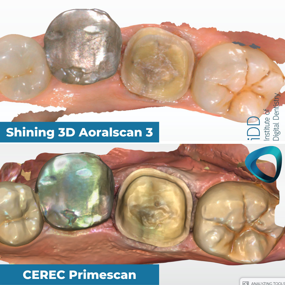 metal-tooth-scan-test-color-render-Shining-3D-Aoralscan-3-vs-CEREC-Primescan-intraoral-scanner-comparison