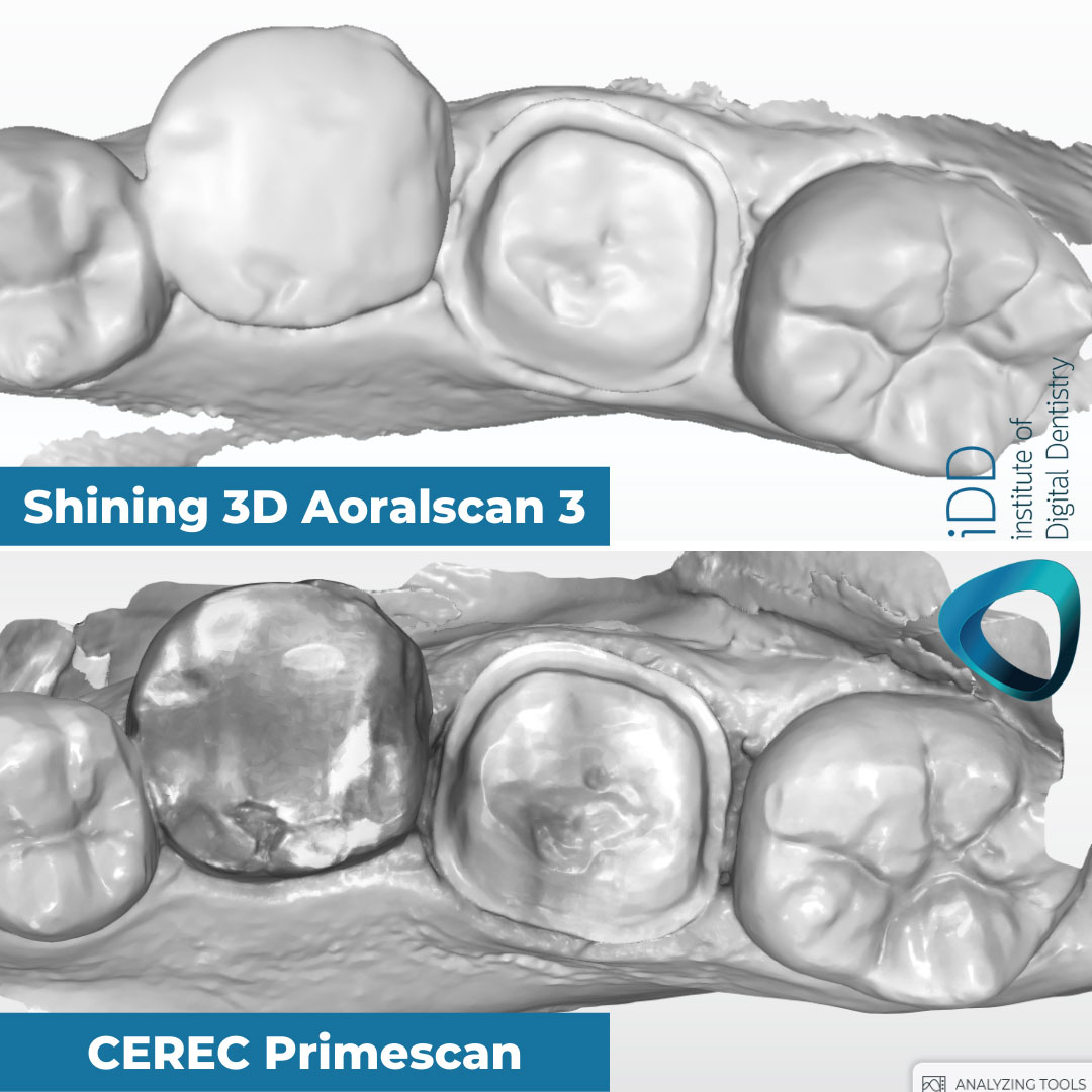 metal-tooth-scan-test-mono-render-Shining-3D-Aoralscan-3-vs-CEREC-Primescan-intraoral-scanner-comparison