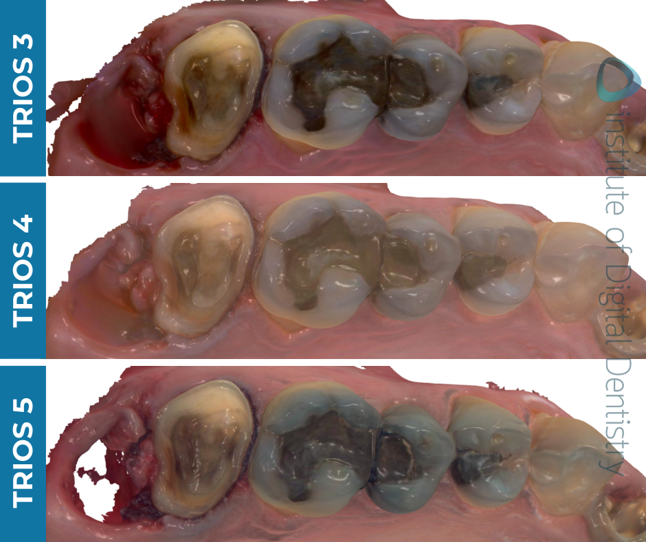 iDD-compares-color-scans-3shape-intraoral-scanner-trios3-trios4-trios5