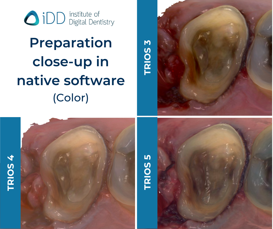 iDD-compares-color-zoom-scans-3shape-intraoral-scanner-trios3-trios4-trios5