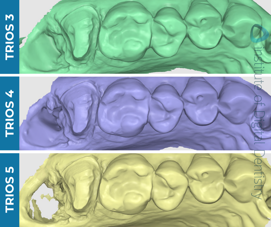 iDD-compares-stl-medit-design-scans-3shape-intraoral-scanner-trios3-trios4-trios5