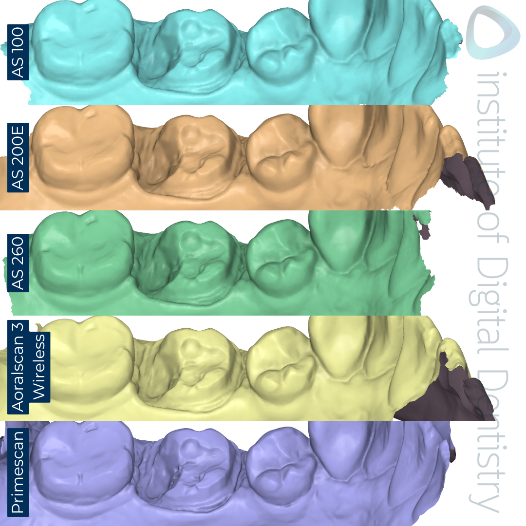 Lingual-margin-prep-Alliedstar-AS-100-AS200E-AS-260-SHINING-3D-Aoralscan-3-Wireless-Dentsply-Sirona-CEREC-Primescan-iDD-Compares-Institute-of-Digital-Dentistry-1x1-1